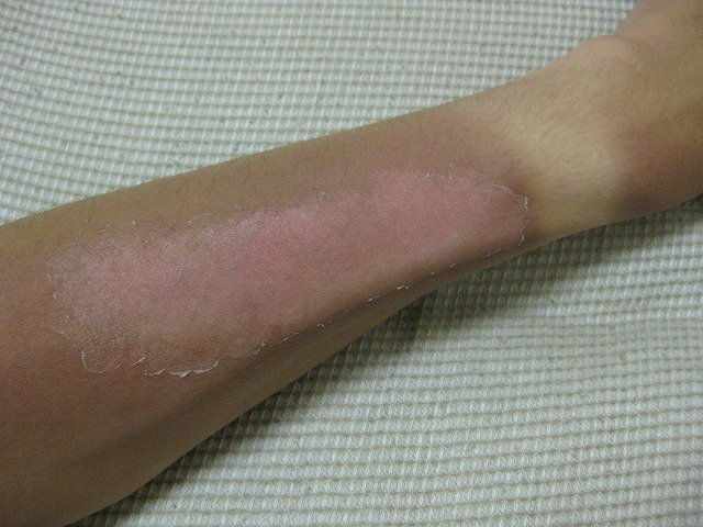 Sunburn example on skin